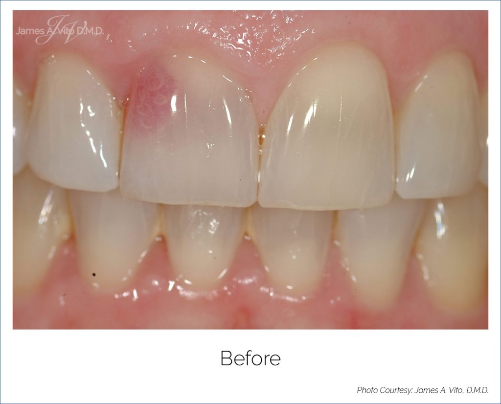 JAMES A VITO DMD Dental Implants Before & After